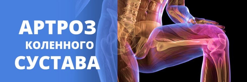 артроз колінного суглоба